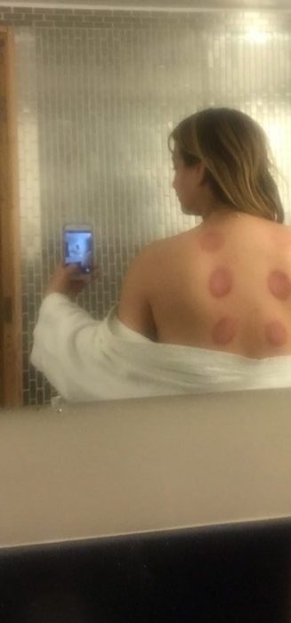 Have you heard of Cupping-8